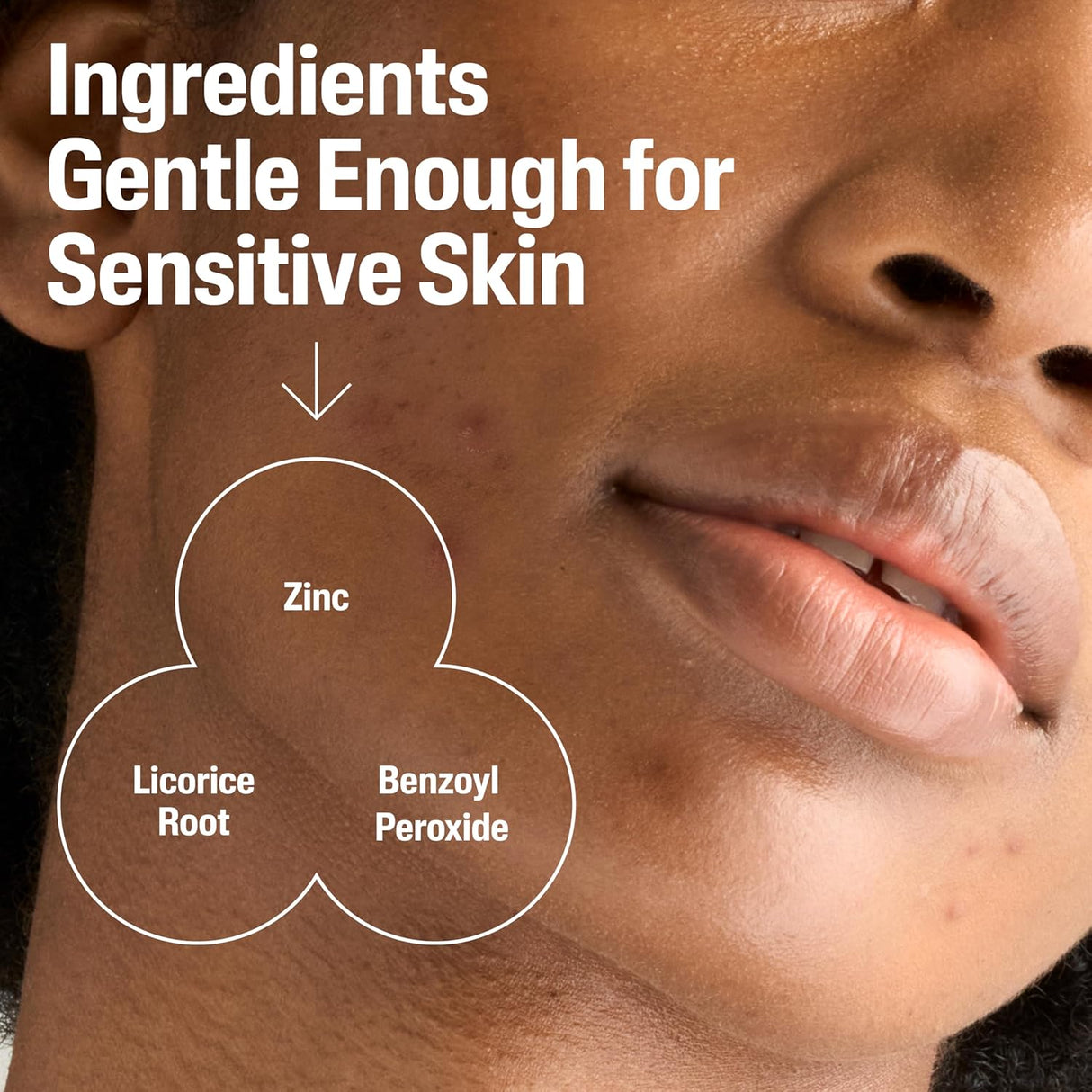 Cetaphil Cleanser 2.6% Benzoyl Peroxide