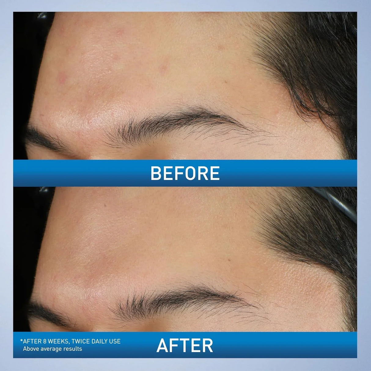 CeraVe Acne Foaming Cream Wash 10% Benzoyl Peroxide - Kenya