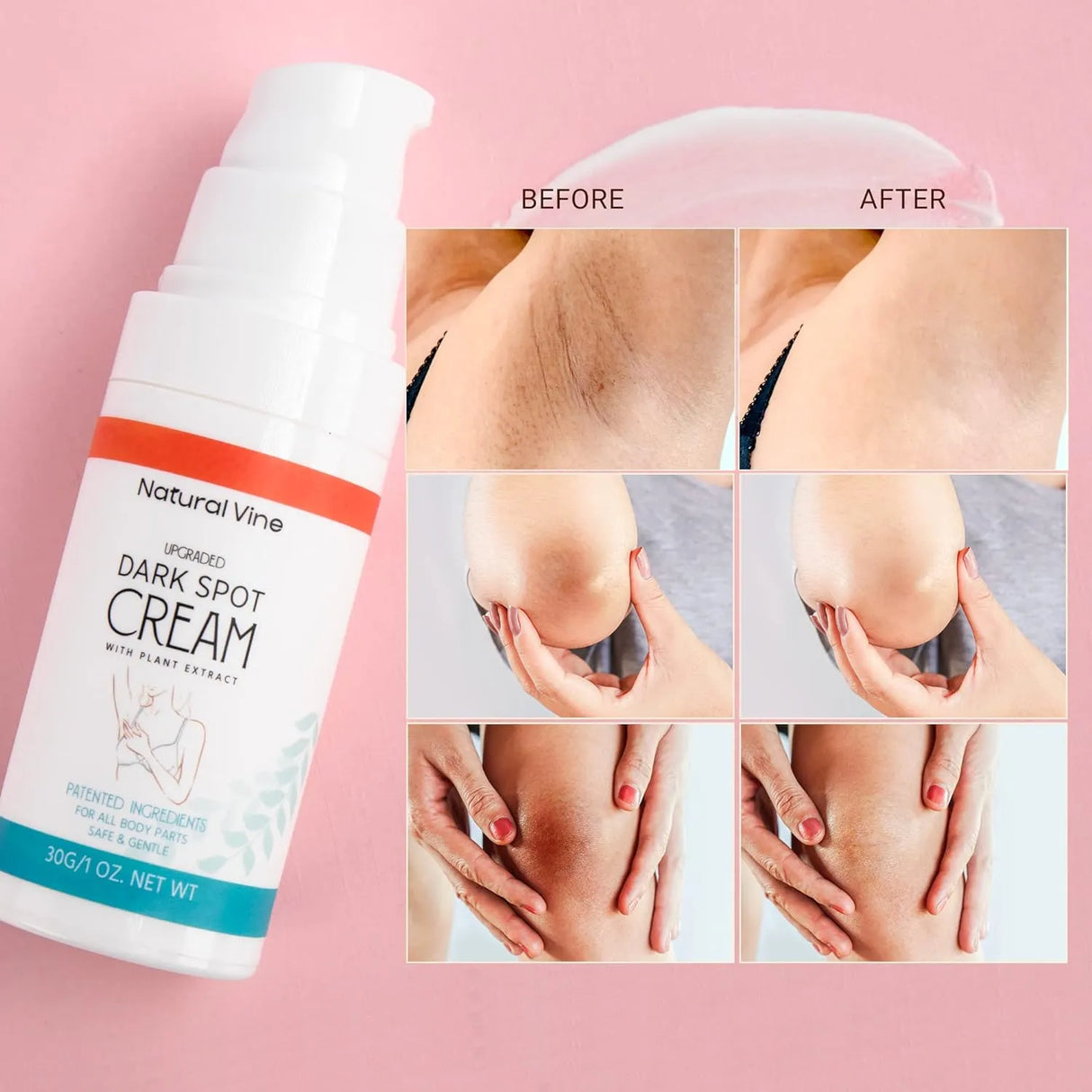 Natural Vine Dark Spot Remover for Body - Kenya