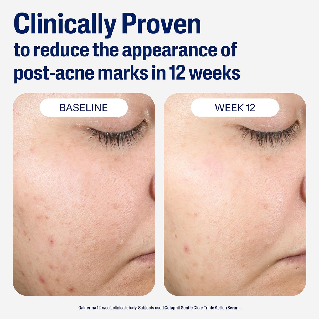 Cetaphil Post-Acne Retinol Alternative Serum