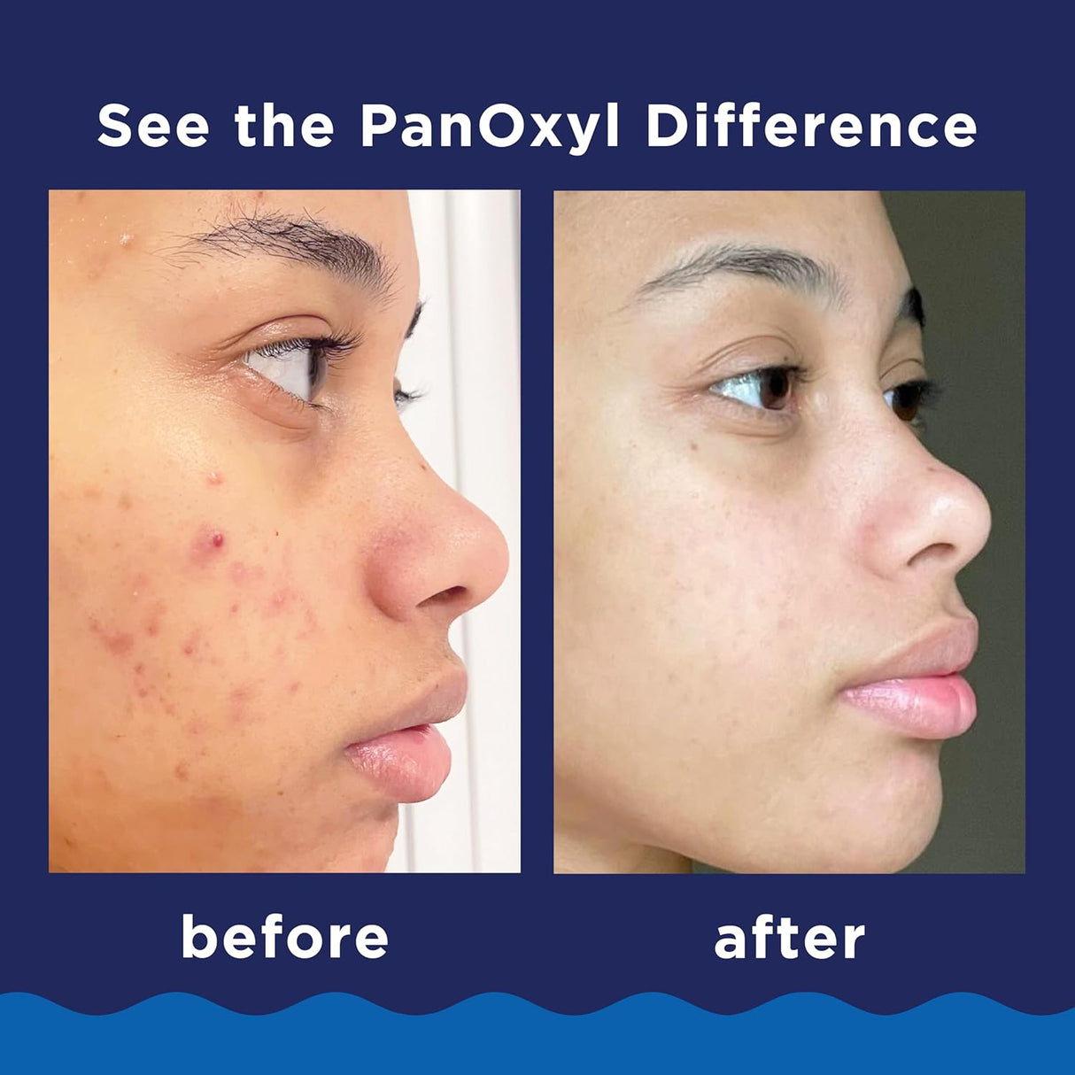 PanOxyl Acne Foaming Wash Benzoyl Peroxide 10% 3.oz 85g