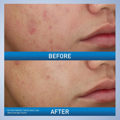 CeraVe Acne Foaming Cream Wash 10% Benzoyl Peroxide - view 3