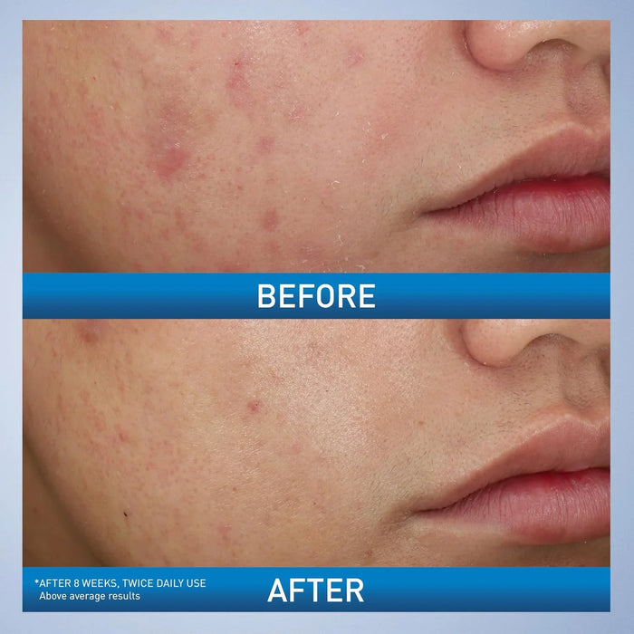 CeraVe Acne Foaming Cream Wash 10% Benzoyl Peroxide