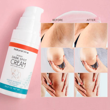 Natural Vine Dark Spot Remover for Body - Kenya