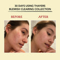 Thayers Blemish Clearing Lemongrass Face Toner with Salicylic Acid image 3