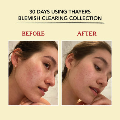 Thayers Blemish Clearing Lemongrass Face Toner with Salicylic Acid - view 3